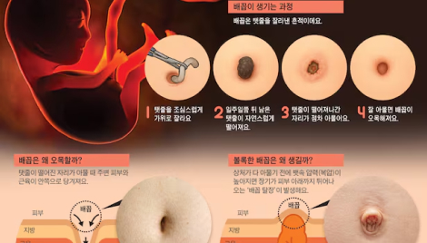 배꼽은 흉터인데 왜 안 사라질까… '배꼽집' 때문