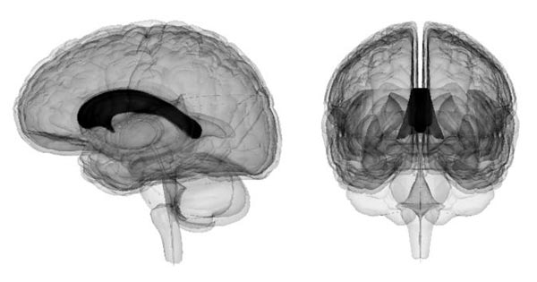 뇌들보(왼쪽·오른쪽 사진 속 검은 부위)는 좌뇌와 우뇌를 연결해주는 10㎝ 길이 신경 다발입니다. 
